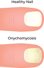 Healthy Nail vs Onychomycosis A Visual Comparison of Nail Fungus Vector Illustration