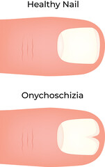 Onychoschizia Healthy Nail vs. Split Nail Condition Comparison Vector illustration