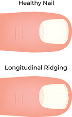 Healthy Nail vs. Longitudinal Ridging Comparison Vector Illustration