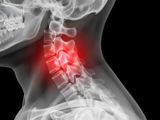 Close-up X-ray style photo of the human neck showing cervical spine bones with a pain area highlighted in bright red. Transparent view of vertebrae, realistic radiographic effect, high detail, medical