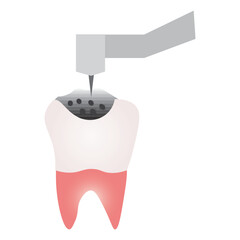 Dental Drilling Illustration