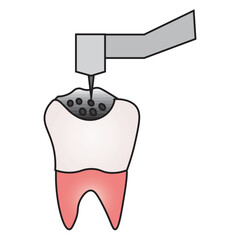 Dental Drilling Illustration