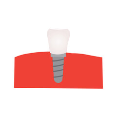 Dental Implant