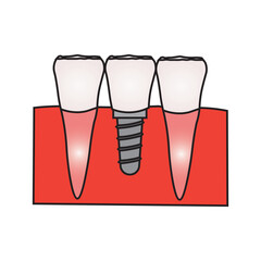 Dental Implant and Tooth Replacement