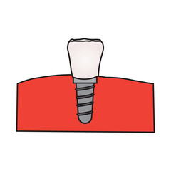 Incisor Dental Implant