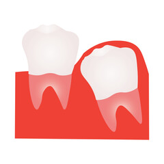 Impacted Wisdom Tooth and Dental Problem Illustration