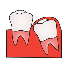 Impacted Wisdom Tooth and Dental Problem Illustration