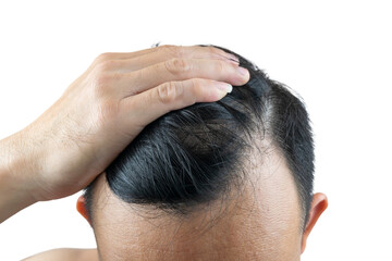 A close-up shot of an Asian man's hand resting on his thinning, dark hair, clearly showing signs of male pattern baldness (androgenetic alopecia) or hair loss at the hairline and crown.