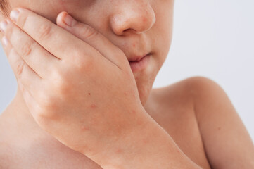 Rash on the body and hands of a child Coxsackie virus