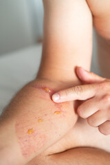 Close-up of an arm wound with applied healing ointment. Concept of first aid, wound care, and treatment of skin injuries.