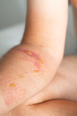 Close-up of an arm wound with applied healing ointment. Concept of first aid, wound care, and treatment of skin injuries.
