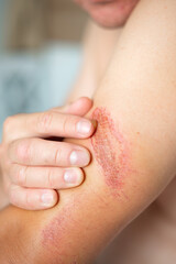 Close-up of an arm wound with applied healing ointment. Concept of first aid, wound care, and treatment of skin injuries.