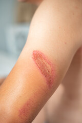 Close-up of an arm wound with applied healing ointment. Concept of first aid, wound care, and treatment of skin injuries.