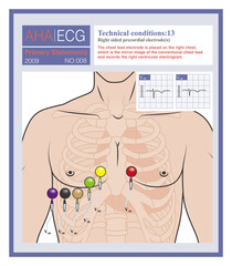The right chest lead is to place a chest lead electrode on the right chest, which is the mirror image of the left chest lead, and is used to explore the right ventricular electrocardiogram.
