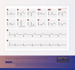 A patient with acute inferior and anterior myocardial infarction(MI) caused by distal occlusion of the RCA  and one day later, combined with occlusion of the LAD, caused high lateral and anterior MI.
