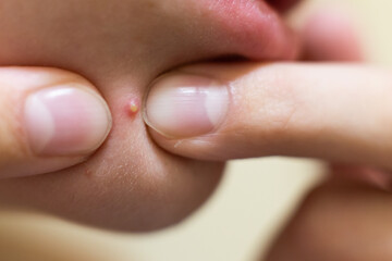Fingers squeezing a whitehead pimple on skin