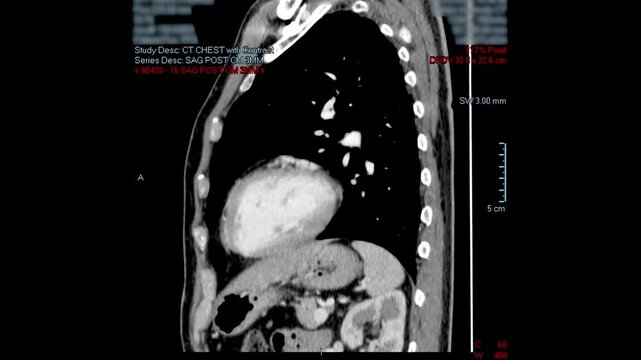 Chest CT scan of a male patient showing the spread of thymus cancer, the cause of Myasthenia Gravis.