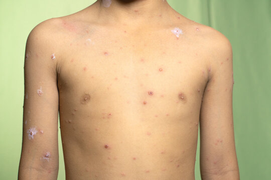 portrait of a boy suffering from smallpox on the front of his body