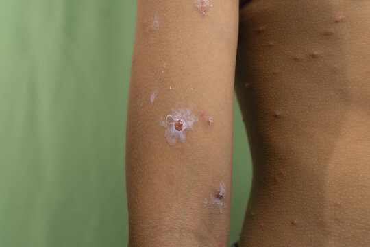 close up of smallpox on a boy's arm.