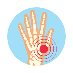 Visual representation of rheumatoid polyarthritis affecting hands with focus on pain in the joint area in a simple vector style