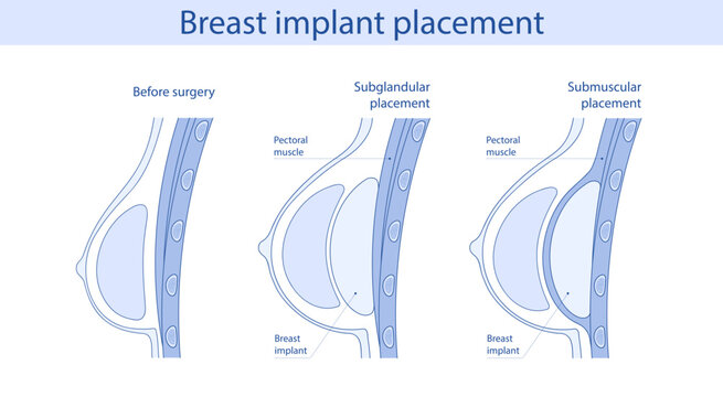 Breast implant placement diagram. Subglandular and submuscular types of placement. Medical illustration plastic surgery of breast implants.