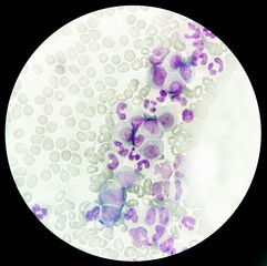 Chronic myeloid leukemia cells or CML, analyze by microscope