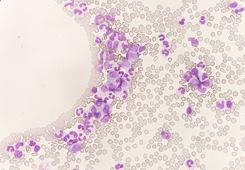 Chronic myeloid leukemia cells or CML, analyze by microscope