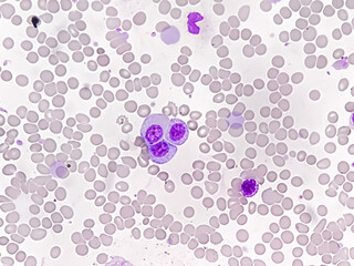 Chronic myeloid leukemia cells or CML, analyze by microscope