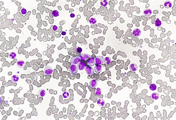 Chronic myeloid leukemia cells or CML, analyze by microscope