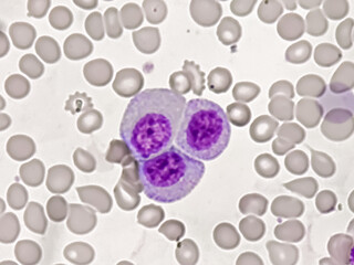 Chronic myeloid leukemia cells or CML, analyze by microscope
