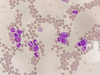 Chronic myeloid leukemia cells or CML, analyze by microscope