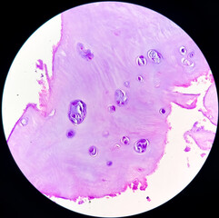 PhotoMicrograph of histological slide:
Specimen: Tissue from L4-5 disc space,
Microscopic Exam: Degenerative fibrocartilage,
Diagnosis: Compatible with intervertebral disc.