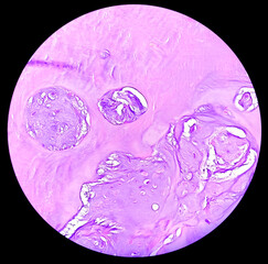 PhotoMicrograph of histological slide:
Specimen: Tissue from L4-5 disc space,
Microscopic Exam: Degenerative fibrocartilage,
Diagnosis: Compatible with intervertebral disc.