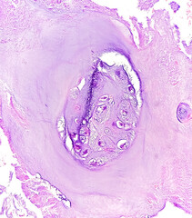 PhotoMicrograph of histological slide:
Specimen: Tissue from L4-5 disc space,
Microscopic Exam: Degenerative fibrocartilage,
Diagnosis: Compatible with intervertebral disc.