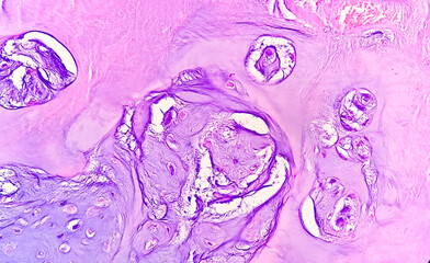 PhotoMicrograph of histological slide:
Specimen: Tissue from L4-5 disc space,
Microscopic Exam: Degenerative fibrocartilage,
Diagnosis: Compatible with intervertebral disc.