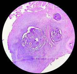PhotoMicrograph of histological slide:
Specimen: Tissue from L4-5 disc space,
Microscopic Exam: Degenerative fibrocartilage,
Diagnosis: Compatible with intervertebral disc.