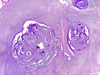PhotoMicrograph of histological slide:
Specimen: Tissue from L4-5 disc space,
Microscopic Exam:...