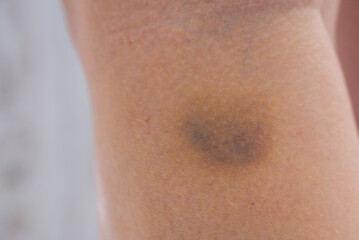 Fototapeta premium Unrecognized person with bruises on body at home scene. Close-up of woman with bruised leg. Bruising leg area, injury accident. Concept of home abuse. Consequences of domestic violence