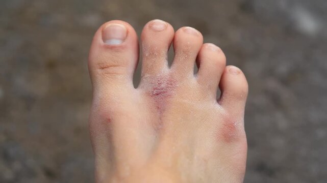 Close up view of a bruised and swollen foot showing injury between the big toe and second toe against a blurred background