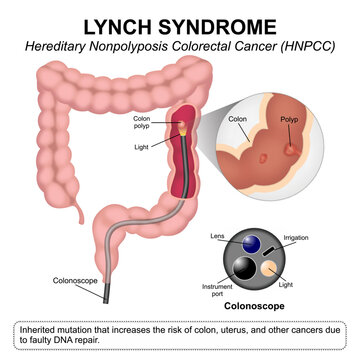 Lynch syndrome - Hereditary Nonpolyposis Colorectal Cancer