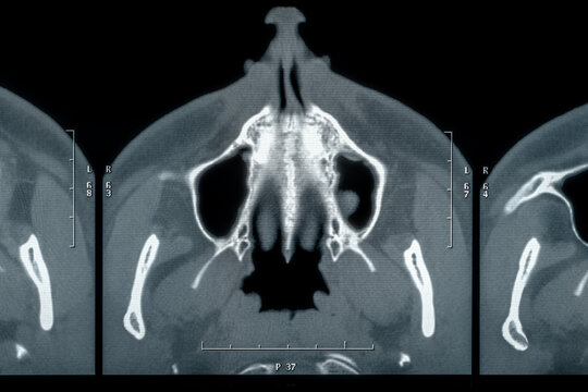 CT examination of the paranasal sinuses xray film contrast image