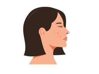 Woman face with acne, acne skin problems