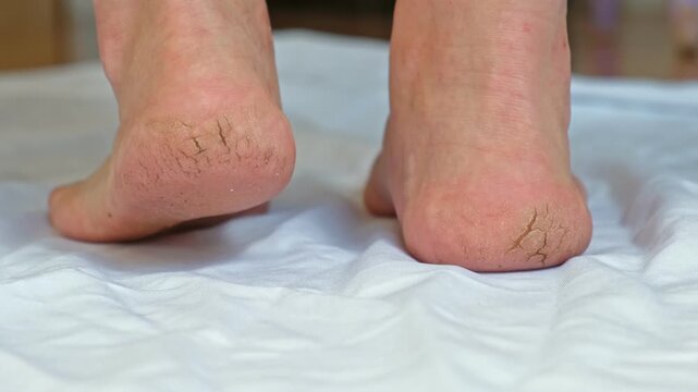 Cracked heel of a female foot with small bleedings and wounds. Dry Skin crack on womans or mans foot heel. Close-Up. Foot Care, Skincare, and Pedicure Concept with Flaky Skin and Calluses. Real video