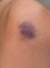 Fototapeta premium Bruise on a woman leg. Selective focus.