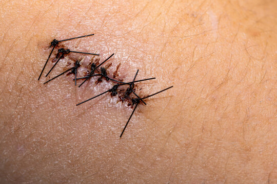 Black surgical sutures before their removal from the wound. Close up of wound healing following shoulder surgery.
