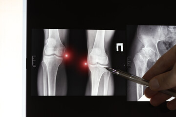 Doctor learn X-ray of dysplastic coxarthrosis of human legs.