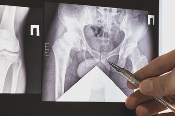 Doctor learn X-ray of dysplastic coxarthrosis of human legs.