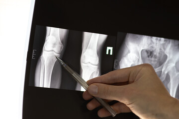 Doctor learn X-ray of dysplastic coxarthrosis of human legs.