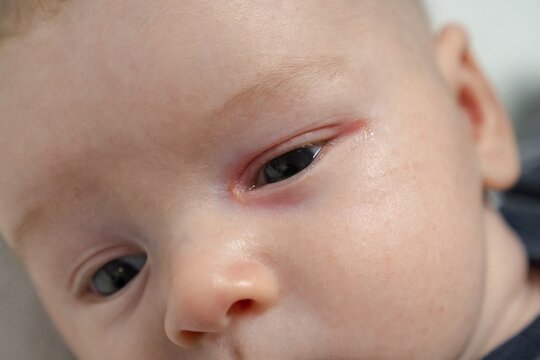 Baby eyes with eye mucus in selective focus. Disease tear ducts tons of newborns close up. Nasolacrimal duct obstruction in baby it is a blockage of the lacrimal drainage system. 