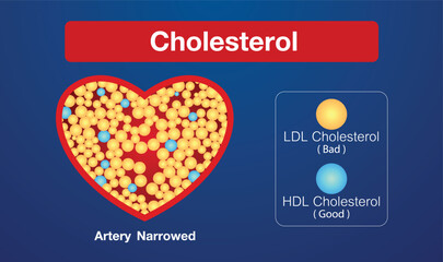 Cholesterol in artery, health risk , vector design